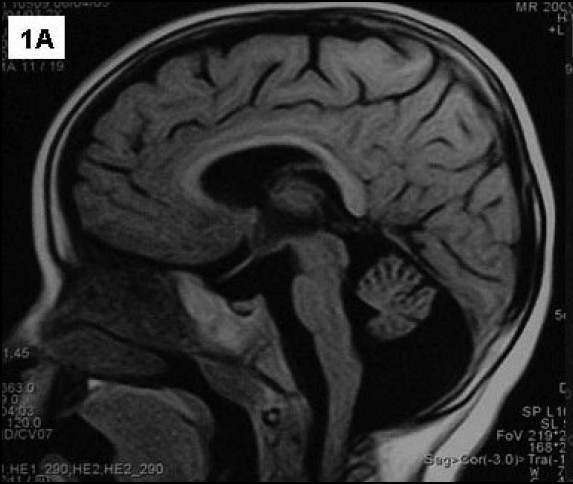 MRI of the brain indicating cerebellar atrophy. a A sagital T1 image