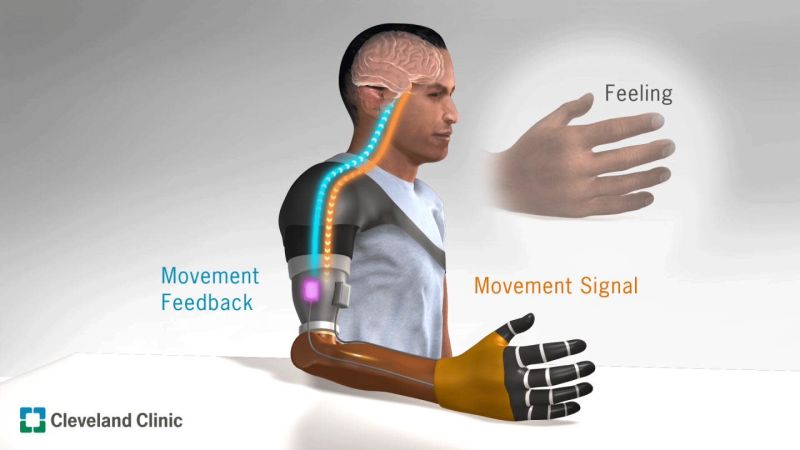 Prosthetic Sensory Feedback - NeuroLogica Blog